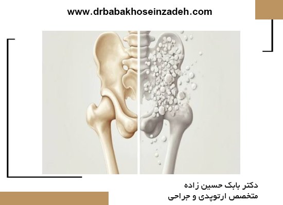 علائم پوکی استخوان 