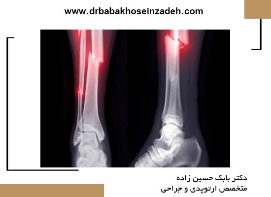 فیزیوتراپی عضو آسیب‌دیده