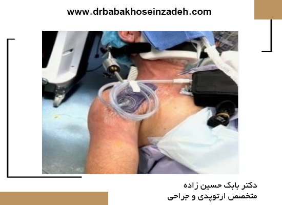 مراقبتهای بعد از عمل شانه