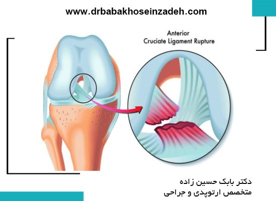 رباط صلیبی قدامی (ACL) 