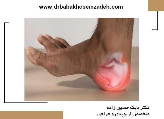 روشهای تشخیص خار پاشنه