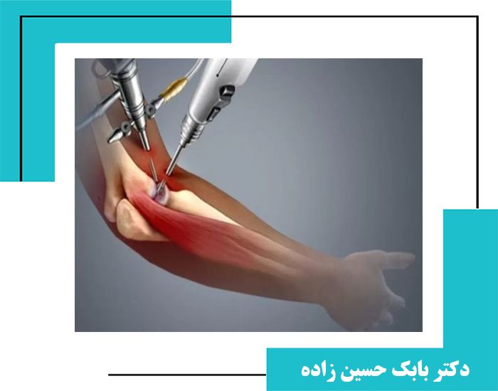 آرتروسکوپی آرنج؛ تشخیص و درمان مشکلات مفصل آرنج
