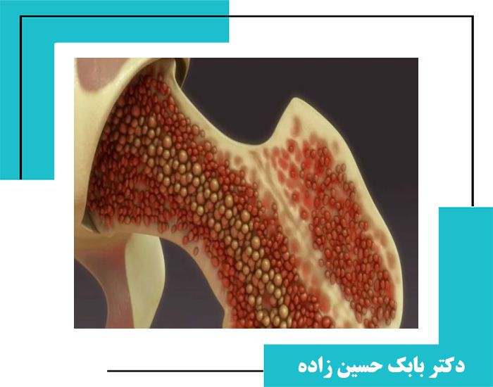 مقاله علمی - تحلیل عملکرد تزریق پیآرپی و کنسانتره مغز استخوان برای درمان آرتروز زانو