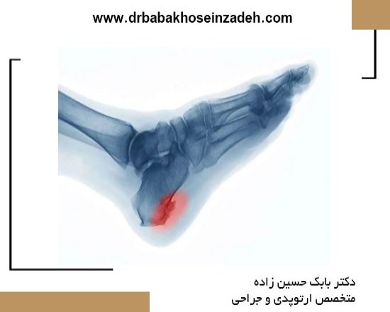 تشخیص و درمان خار پاشنه پا؛ روش‌های نوین و غیرجراحی