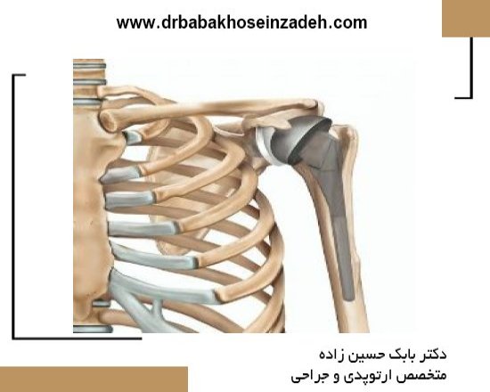 همه چیز درباره جراحی تعویض کامل مفصل شانه