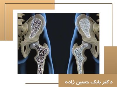 پوکی استخوان چیست ؟ آیا واقعا خطرناک است ؟