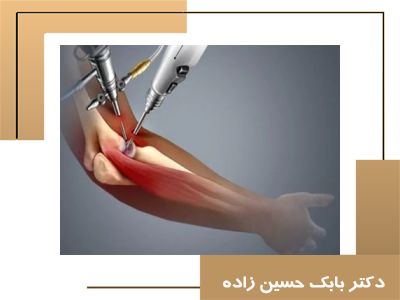 آرتروسکوپی آرنج؛ تشخیص و درمان مشکلات مفصل آرنج