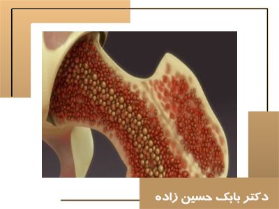 مقاله علمی -  تحلیل عملکرد تزریق پی‌آرپی و کنسانتره مغز استخوان برای درمان آرتروز زانو