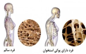 علائم پوکی استخوان